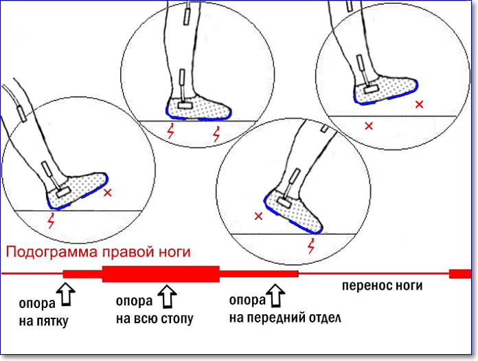 ходьба в специальной обуви с двумя контактами в области пятки и переднего отдела стопы